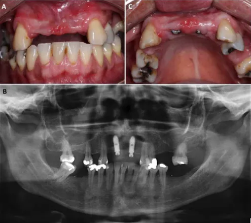 Figure 1.  A) Initial photograph of the case; B) Panoramic view with implants already installed; C) Irregularity of the concave arc.