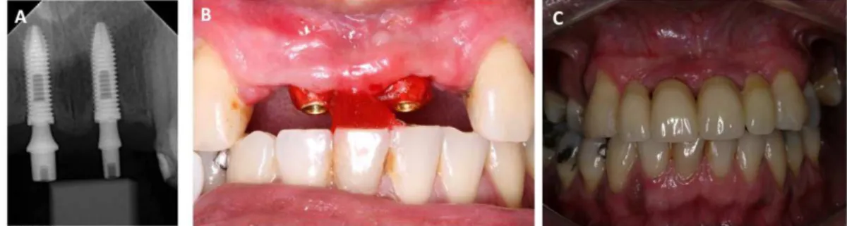 Figure 2.  A) Choice of components; B) Interocclusal recording; C) Installation of the temporary crowns.