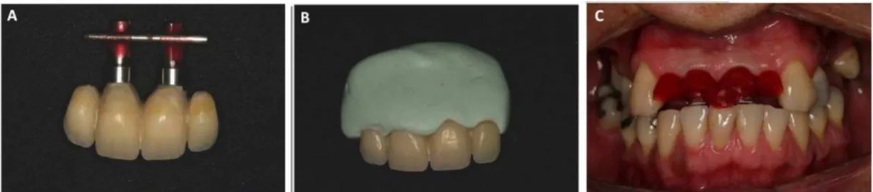 Figure 5.  A and B) Copy of the emergence proile of the temporary crowns; C) Customized transfer components in place for the molding with interocclusal recording