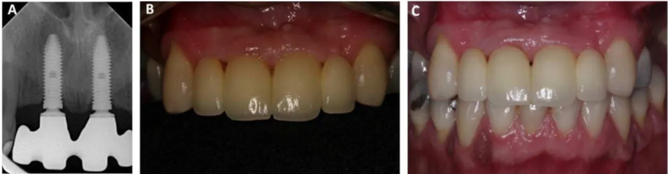 Figure 6.  A) Radiograph of the structure test in zirconia; B) Installed prosthesis; C) Follow-up at 4 months.