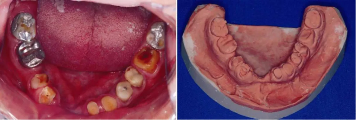 Figure 2.  A) Remaining lower teeth with excessive wear; B) Preliminary model in stone type IV.
