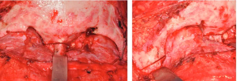 Figure 3. A) Horizontal osteotomy below the fronto-nasal suture. B) Oblique osteotomy of the zygomatic bone (right side).