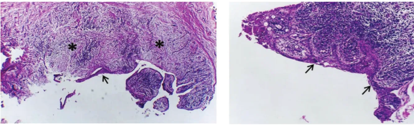 Figure 2. Histopathological image of radicular cyst. The images show the cyst with its cystic capsule (*) coated by stratiied squamous non-keratinized epithelium (→)