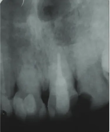 Figure 1. Longitudinal fracture in the apical third.