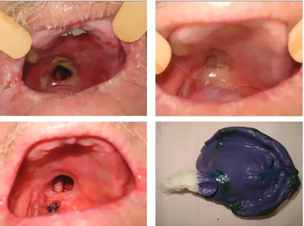 Figure 1 . A) patient initial aspect; B) Silicone obturator plate positioned in the mouth; C) Palate aspect when starting to make the obturator prosthesis; D) Functional molding  with godiva and polyether.