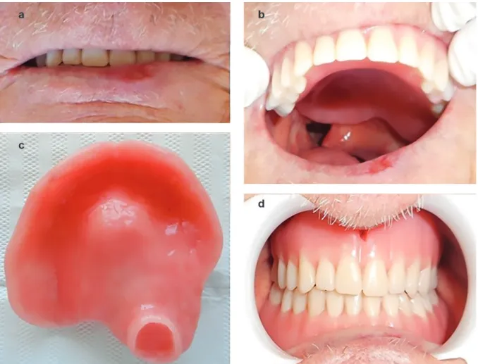 Figure 2 . Patient smiling with the obturator prosthesis in the mouth; B – D) Aspect of the total obturator prosthesis just over 2 years after its installation.