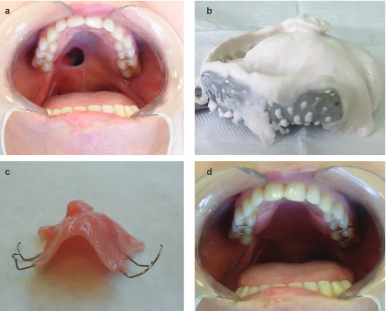 Figure 5 . A) Current aspect of the patient palate.B) Molding with alginate.C)  Provisional obturator prosthesis.D) Provisional obturator prosthesis installed.