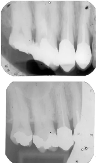 Figure 1. A and B - Antemortem periapical x-rays of dental elements 14, 15, 16 and 17  without digital processing