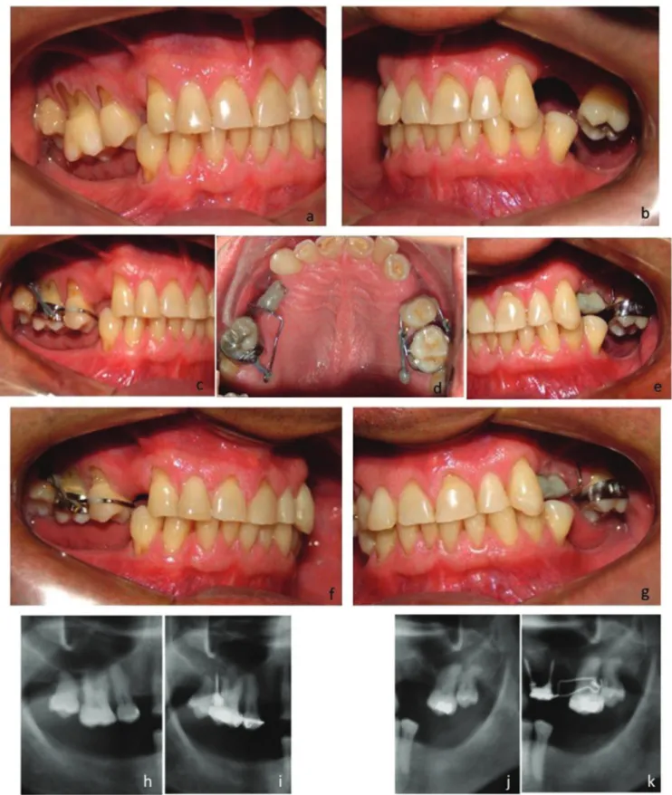 Figure 1. A, B - Absence of mandibular molars, extrusion and mesial tipping of maxillary teeth; Right and left side views; C - D - and: Vestibular and palatine mini-implants  for intrusion
