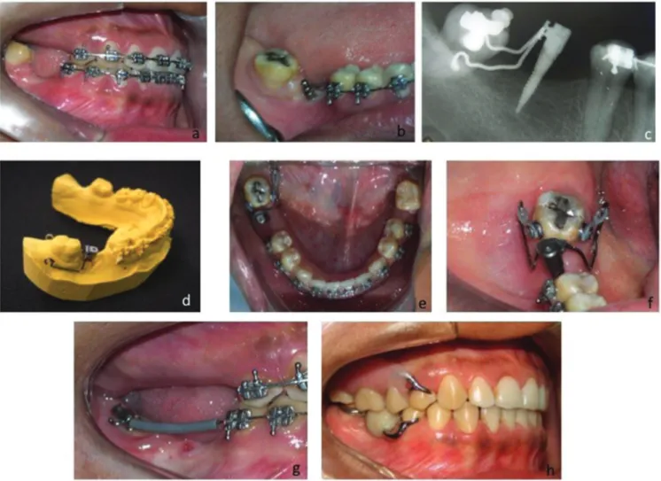 Figure 3. A - Absence of maxillary molars and extrusion of tooth 47; B - Insertion of orthodontic mini-implant (2.0 mm in diameter and 10mm long); C - D, Radiographic  image of orthodontic mini-implant and orthodontic abutment cemented