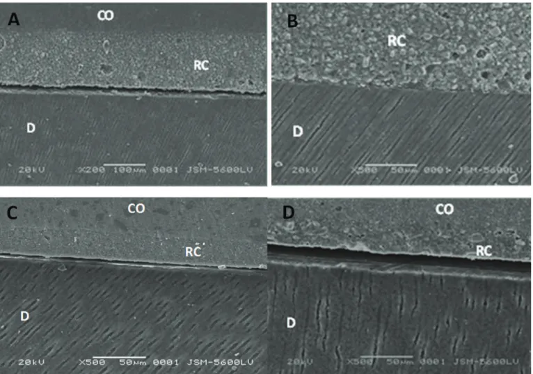 Figure 2. A) SEM micrograph (G1), Panavia, (X200,bar100µm,Co=Composite  overlay, C=Resin Cement, D=Dentin)