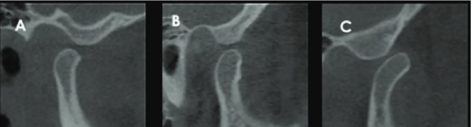 Figure 2. Sagittal sections of right TMJ in maximum mouth opening with condylar mobility.