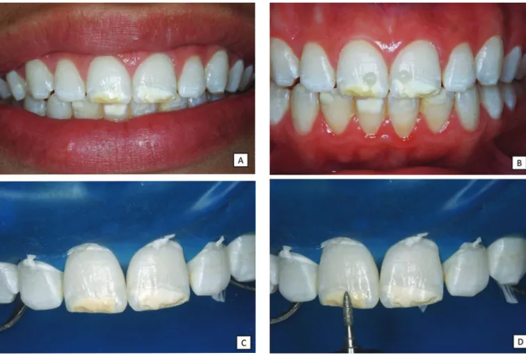 Figure 1. Clinical steps in conservative restorative treatment. A) Frontline smiling photo with morphological features of teeth 11 and 21