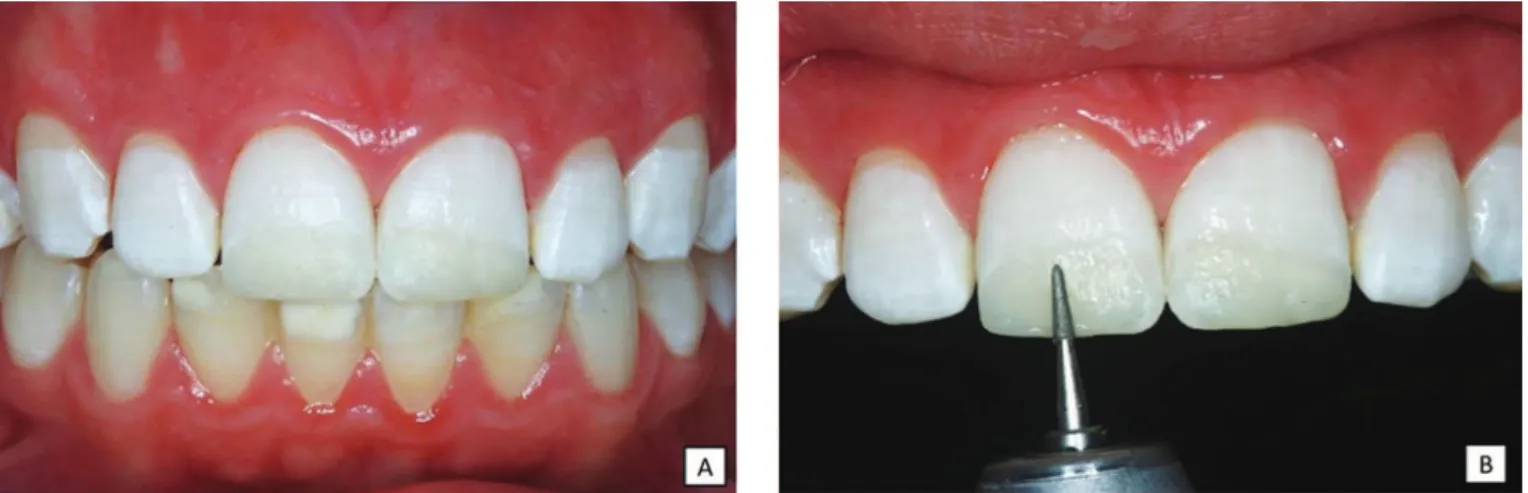 Figure 4. A) View immediately after removing absolute isolation. B) Initial inishing with diamond bur F.