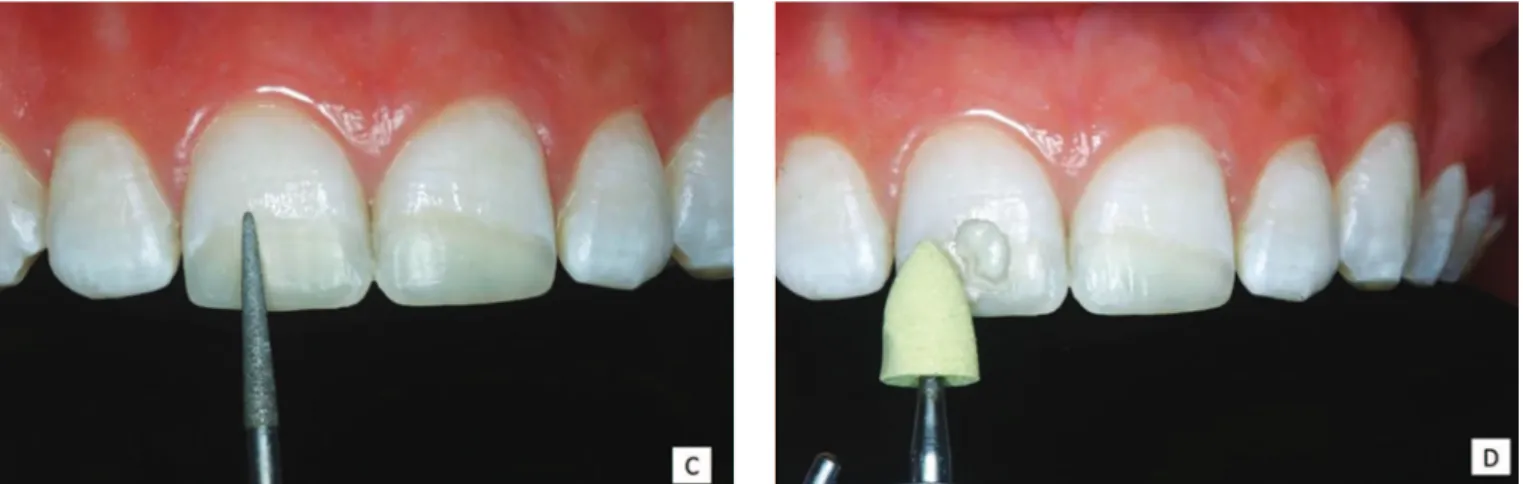Figure 4.  C) 2nd session, inishing with diamond bur F/F.  D) Initial polishing with yellow rubber cup (thicker granulate).