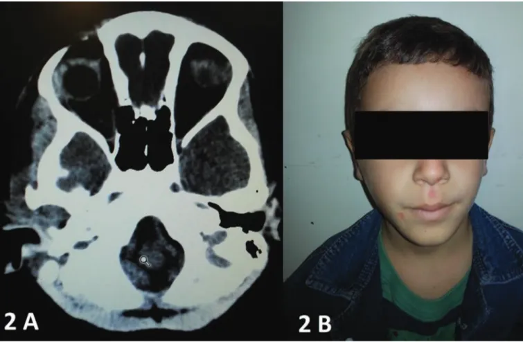 Figure 2. A) Axial CT image showing purulent luid within the right TMJ. B) Appearance of patient 5 weeks after hospital discharge.