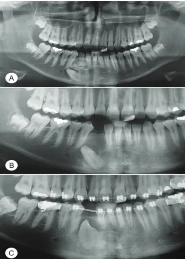 Figure 1. A) Panoramic radiographic showing impacted permanent mandibular  right canine with radiopaque image surrounded by radiolucent area; 