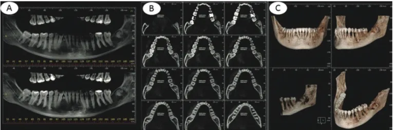 Figure 1. Computed tomography: (A) panoramic image; (B) axial sections; C) 3D reconstruction.