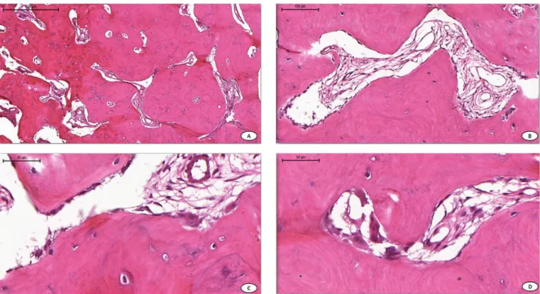 Figure 2. Histopathologic features: (A) presence of mineralized material in the form of irregular vital trabeculae interspersed in a ibrovascular stroma; (B) osteocytes trapped  in the bone matrix; (C) pavement of osteoblasts; (D) multinucleated giant cell