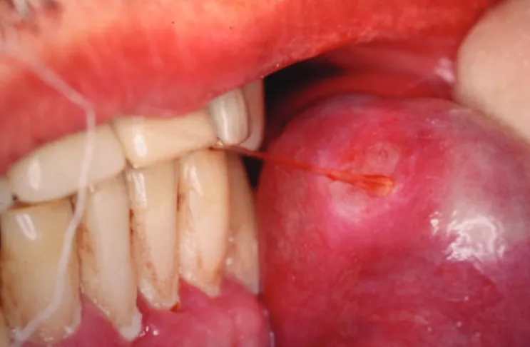Figure 1. Injury covered by intact mucosa presenting point of mucosal luid drain- drain-age.