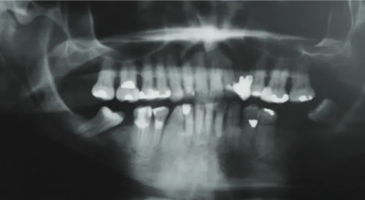 Figure 3. Clinical appearance of exposed bone at the right mandibular second molar.