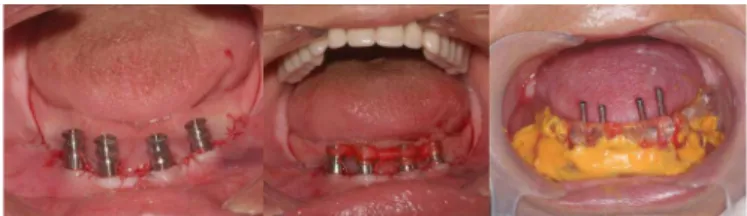 Figure 2. Adaptation of mini-piers on implants and molding with open molders.
