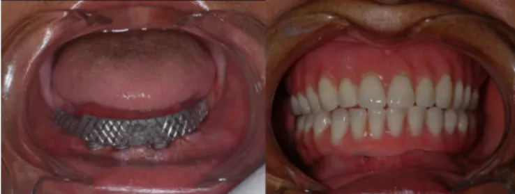 Figure 3. Postoperative of 2 days, metallic superstructure and hybrid prosthesis type  protocol installed.