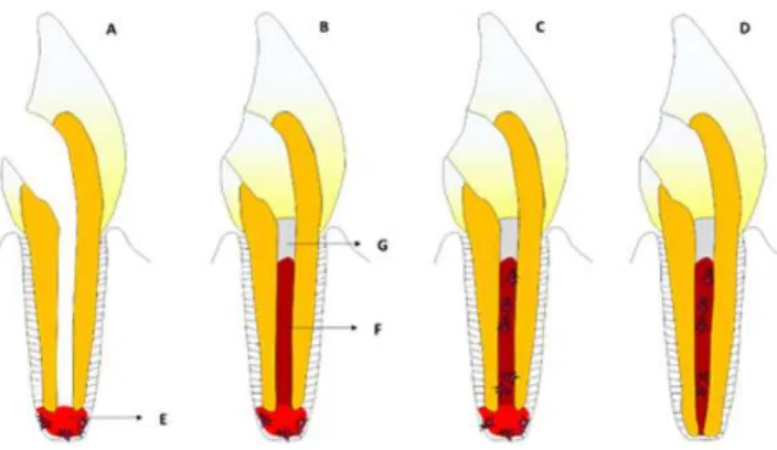 Figure 4. Schematic drawing of the root canal revascularization principle. A) Necrotic  permanent tooth with incomplete apex B) Blood clot formation and MTA  plug application; C) Migration of apical papilla stem cells; D) Continuation  of root development;