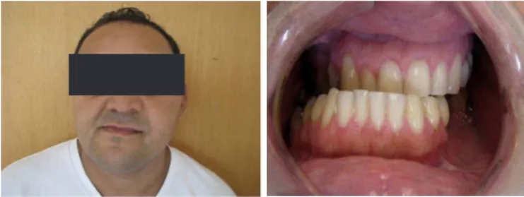 Figure 1. A and B - At the clinical examination, the patient presented severe man- man-dibular lateral deviation to the right, left side disocclusion with a slight oral  opening limitation, dental abrasion compatible with bruxism and class III.
