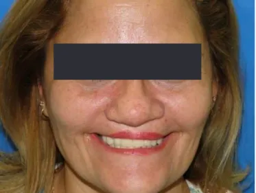 Figure 6. Try-in phase of the teeth and semi-precision attachments.