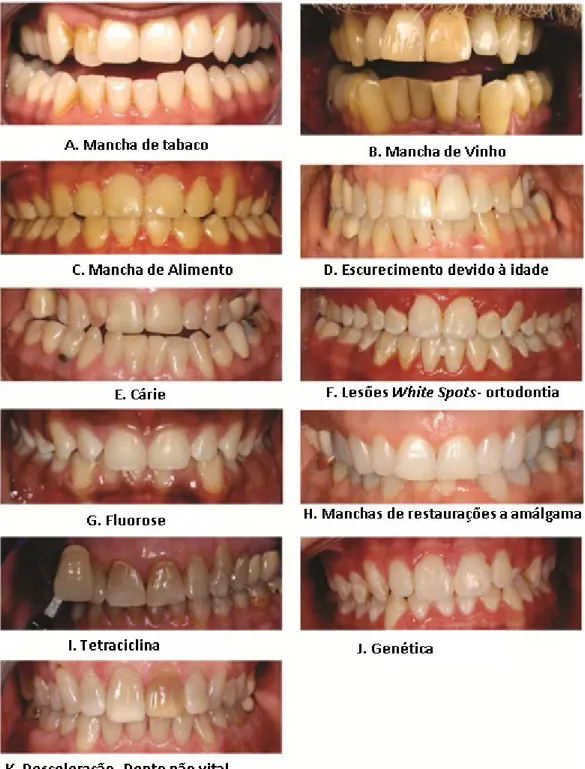 Figura 1- Exemplos de pigmentações dentárias. Pigmentação extrínseca: A; B e C. Pigmentação intrínseca: 