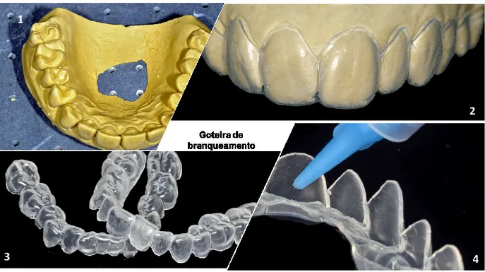 Figura 10- Confeção da goteira de branqueamento. 1: Modelo representativo da boca do paciente; 2: corte  da  goteira  de  forma  festoneada;  3:  Goteira  de  branqueamento;  4:  demonstração da  aplicação  do gel  de  branqueamento