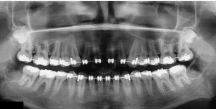 Figure 1. Panoramic radiograph showing a radiolucent image with discrete radi- radi-opaque point inside it and well defined margins in the region of the  ascending ramus of the mandible on the left.