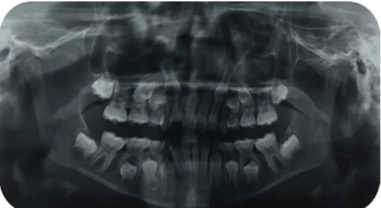 Figure 1. Panoramic radiograph showing the tooth retained without contact with  oral medium.