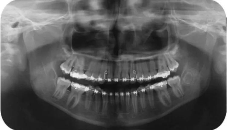 Figure 3. Panoramic radiograph showing the tooth in mouth, without progress of  the lesion.