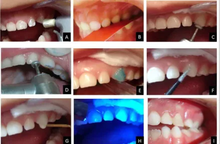 Figure 1. A - prophylaxis; B - carbon paper; C - occlusal adjustment; D - occlusal adjustment; E - conditioning surface; F - insertion of the adhesive agent; G - construction of  the track with composite resin; H – photopolymerization; I - planas direct tr
