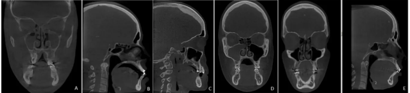 Figure 1.  A. Sinusitis, B. Radiopaque image in the centre of the skull cap, C. Internal frontal hyperostosis, D