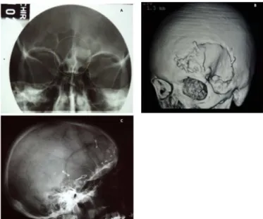 Figure 1. (A) Osteoma before surgery; (B) 3D Reconstruction in lateral position; (C)  Placement of the aneurysm clips in lateral position view.