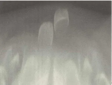 Figure 2. Radiograph showing teeth 71 and 81 in preterm newborn.