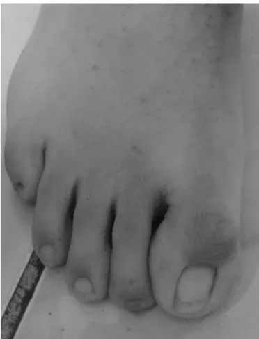 Figure 2. Thick and brittle nails key features of an ectorderm dysplasia patient.