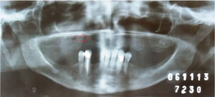 Figure 1. Panoramic x-ray, the arrow identifying the well-delimited radiolucent le- le-sion next to the floor of the right nostril, measuring approximately 1.5  cm at its largest diameter.