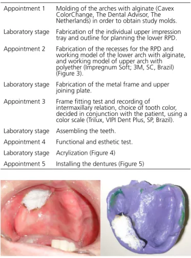 Figure 2. One week after surgery. A) mouth-sinus communication. B) Complete up- up-per denture rebased with resilient self-polymerizing acrylic resin.