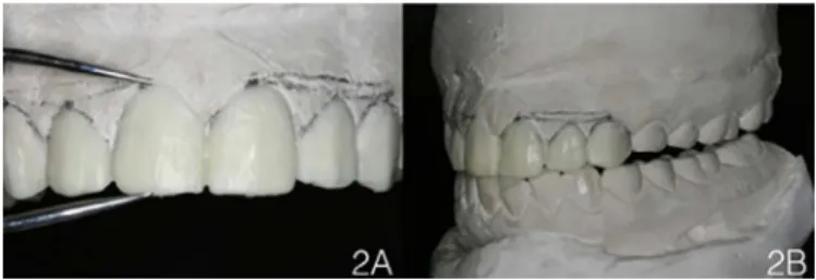 Figure 2. A) Diagnostic Wax-up, observing height/width proportion; Figure 2B)  Mandibular movements visualized in the articulator.