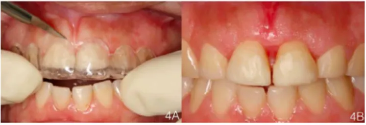 Figure 5. A) Selection of cement shade with try-in pastes; B) Clinical adjustment of  the canine guide after cementation.