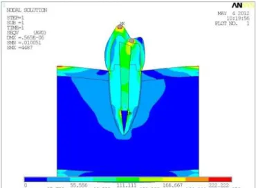 Figure 4. Stress distribution on premolar restored with glass iber post and resin com- com-posite illing core, after oblique load.