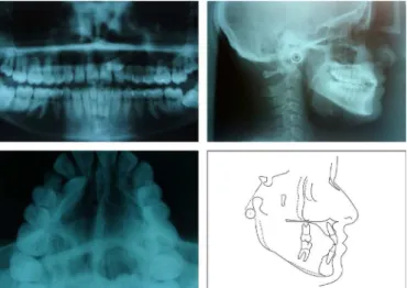 Figure 2. Pretreatment x-rays and cephalometric tracing.