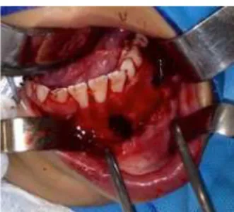 Figure 4. Image of exploratory surgery with the aim of diagnosis. The presence of  an empty cavity was noted.