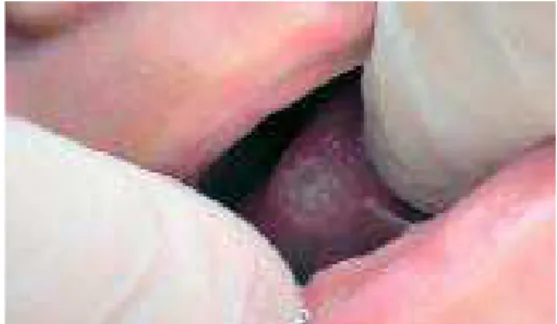 Figure 2. Traumatic ulceration on the ventral surface of the tongue.