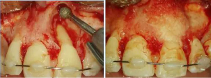 Figure 4. A) Bone defect after removal of the lesion and osteoplasty of the surgical  cavity