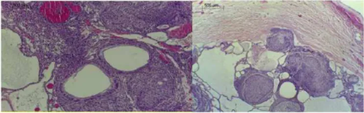 Figure 5. A) Larger increase, evidencing the presence of ductlike structures compris- compris-ing columnar and cuboidal cells